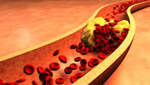 10 alimente cu care elimini depunerile de colesterol de pe vasele sanguine si previi infarctul